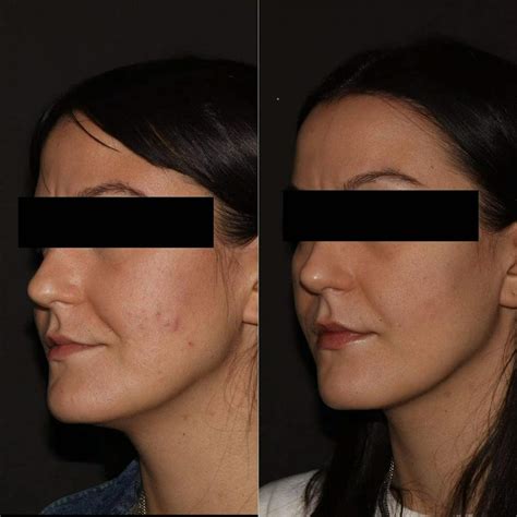 Chemical Peels in St. Louis .